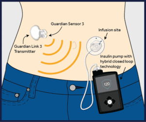 Diagram of an insulin pump.