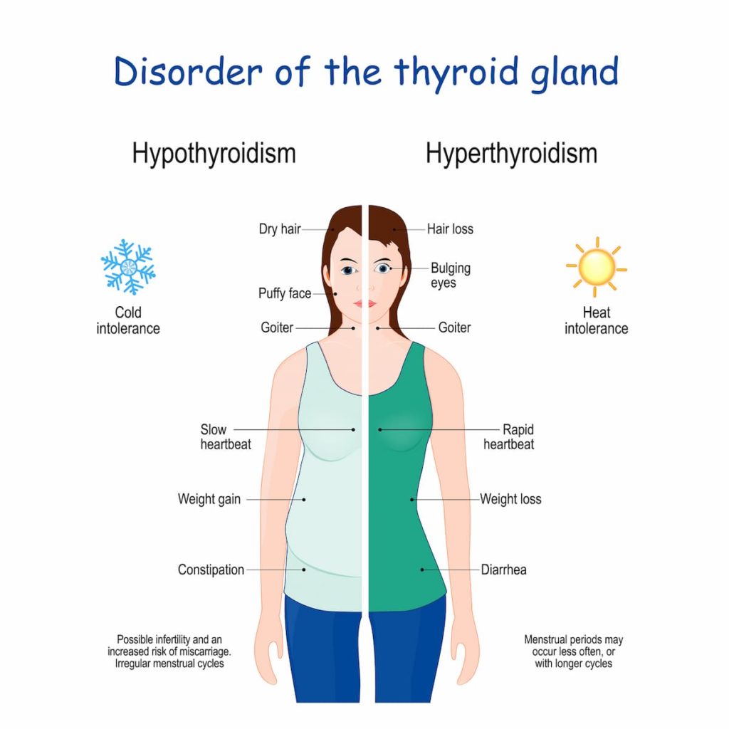 Thyroid gland disorder diagram, as an educational part of the care of our endocrinology specialists in Idaho Falls and Pocatello.