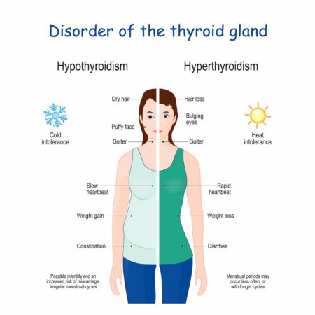 disorder of thyroid gland diagram.