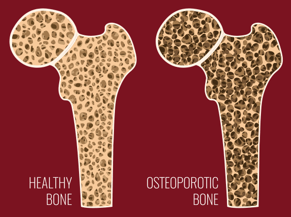 Healthy bone vs osteoporotic bone.